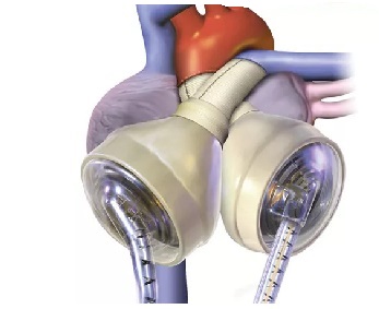 Artificial Heart 