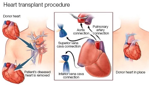Heart Failure Surgeon