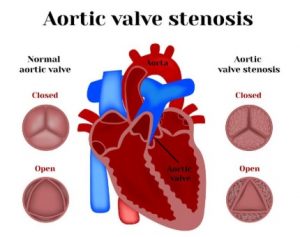 Aortic surgeon